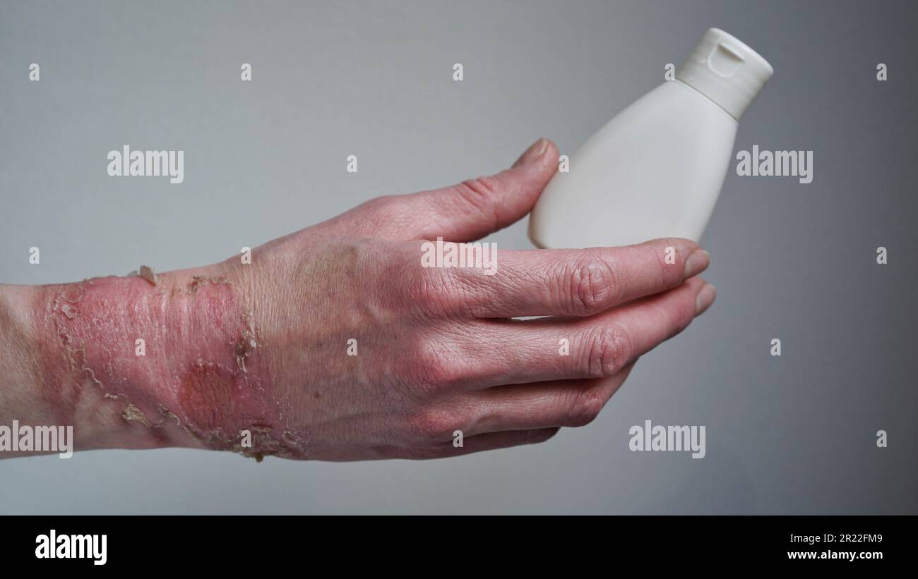 Mockup bottle with cream healing ointment woman hand burned with