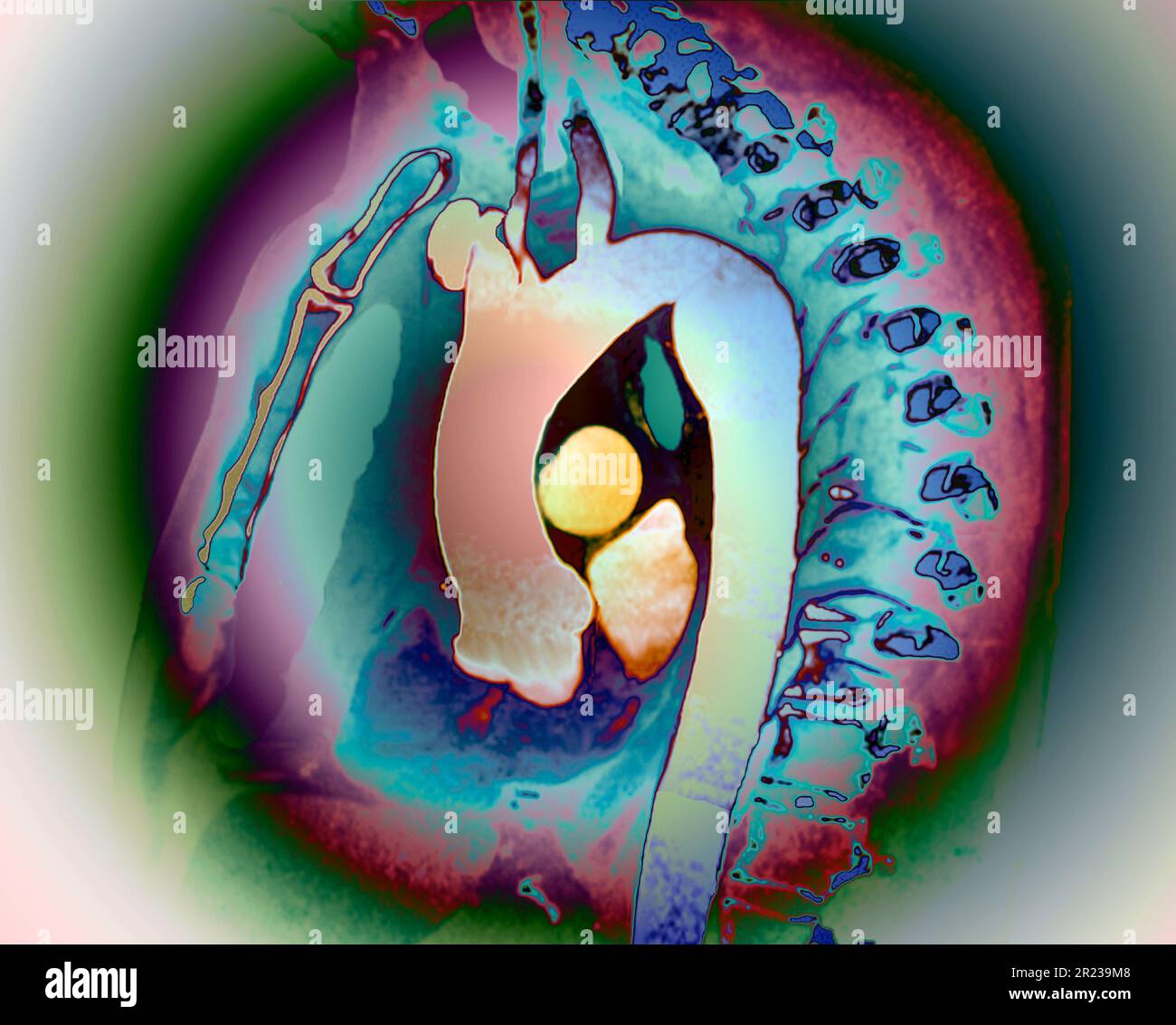 Aortic Aneurysm CT Scan Stock Photo Alamy aortic-aneurysm-ct-scan-stock-photo-alamy