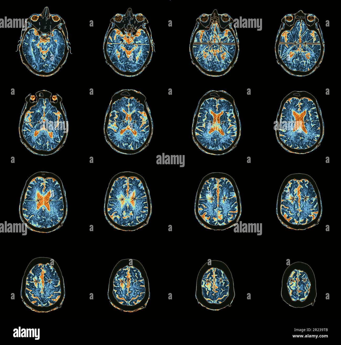 Parkinson's disease electrode implants, CT scans Stock Photo Alamy