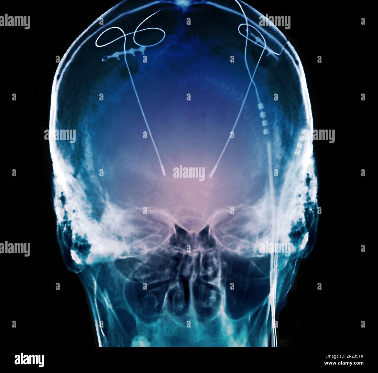 Parkinson's disease electrode implants, Xray Stock Photo Alamy