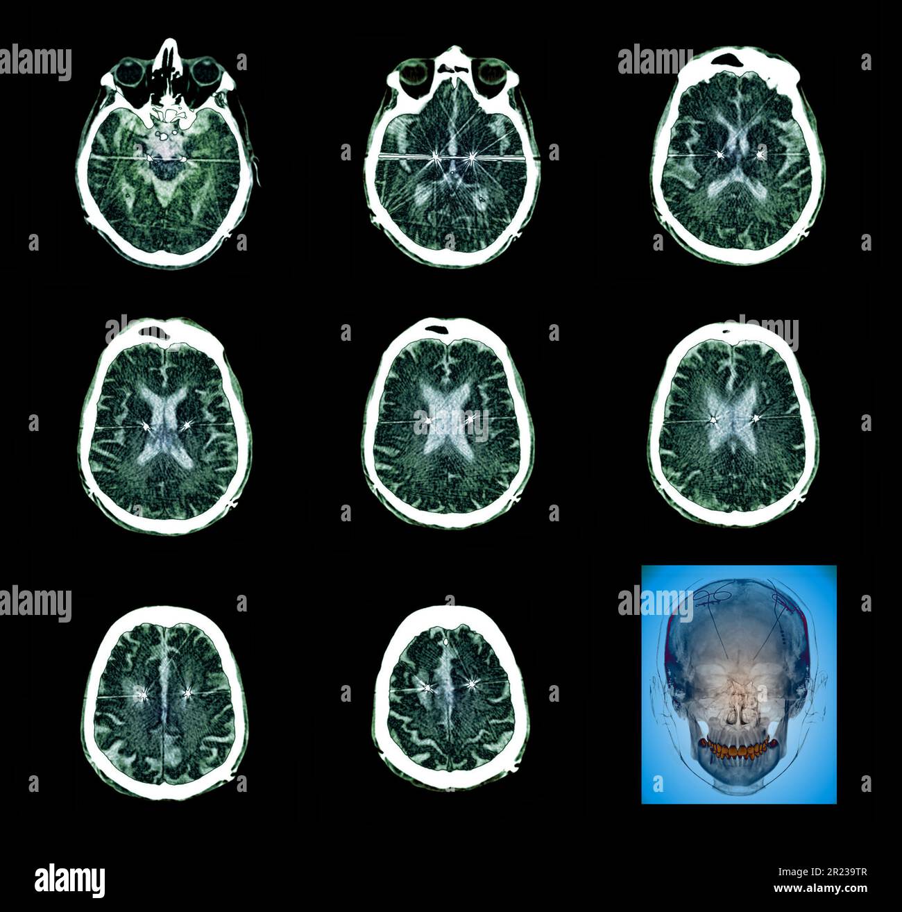 Coloured computed tomography (CT) scans and Xray (bottom right