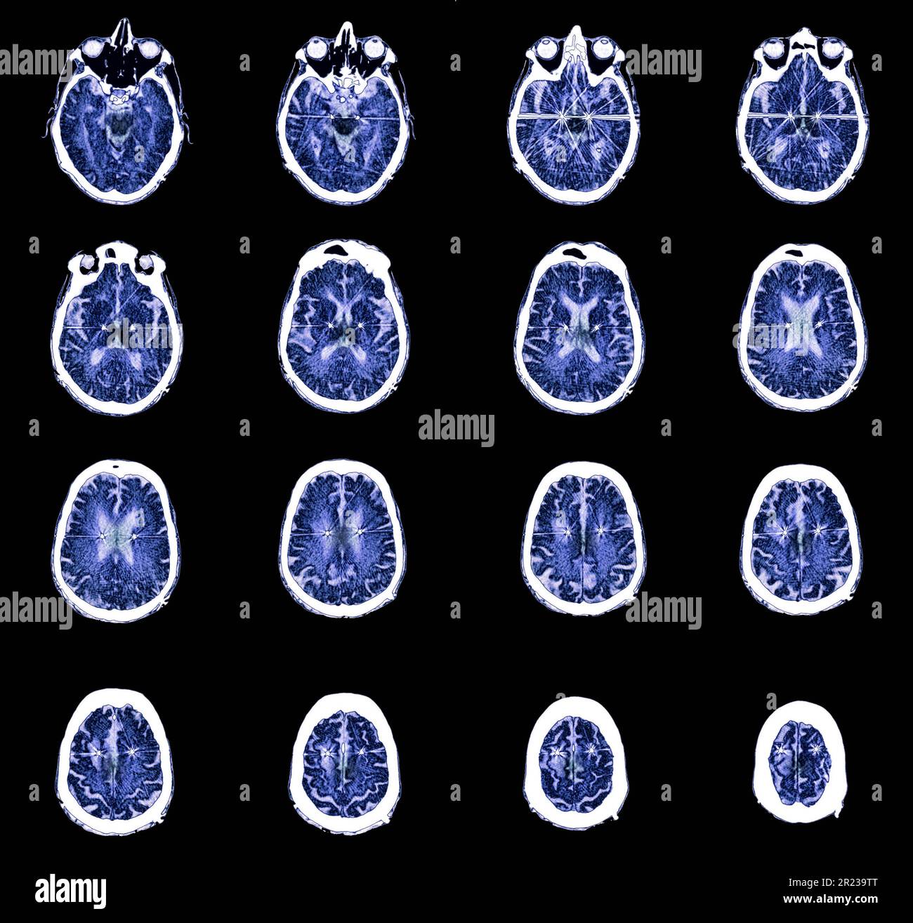 Coloured computed tomography (CT) scans showing electrodes implanted in