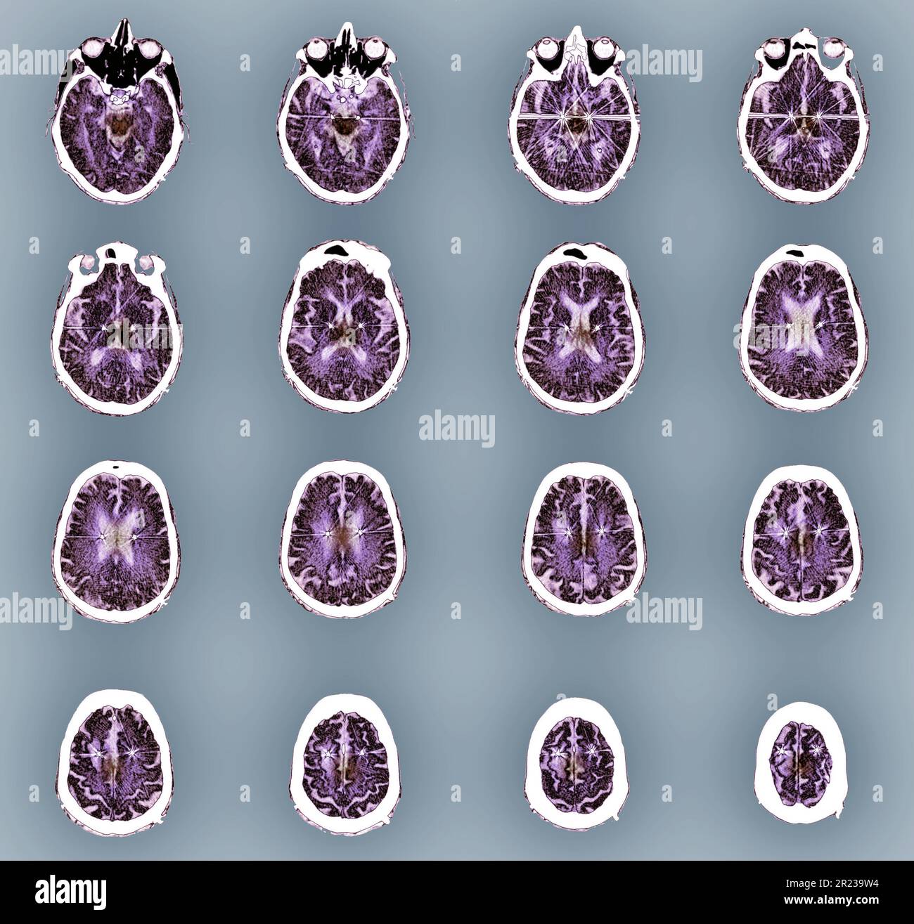 Parkinson's disease electrode implants, CT scans Stock Photo Alamy