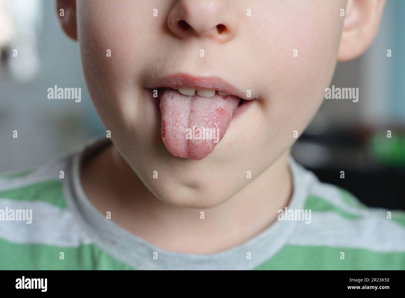 White spots on the kid tongue. Oral thrush is a fungal infection that affects the soft tissue inside the mouth. It is quite common in young children. Stock Photo