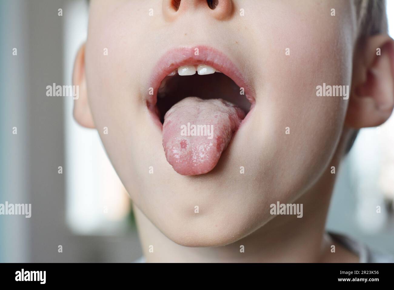 White spots on the tongue. Oral thrush is a fungal infection that affects the soft tissue inside the mouth. It is quite common in young children. Stock Photo