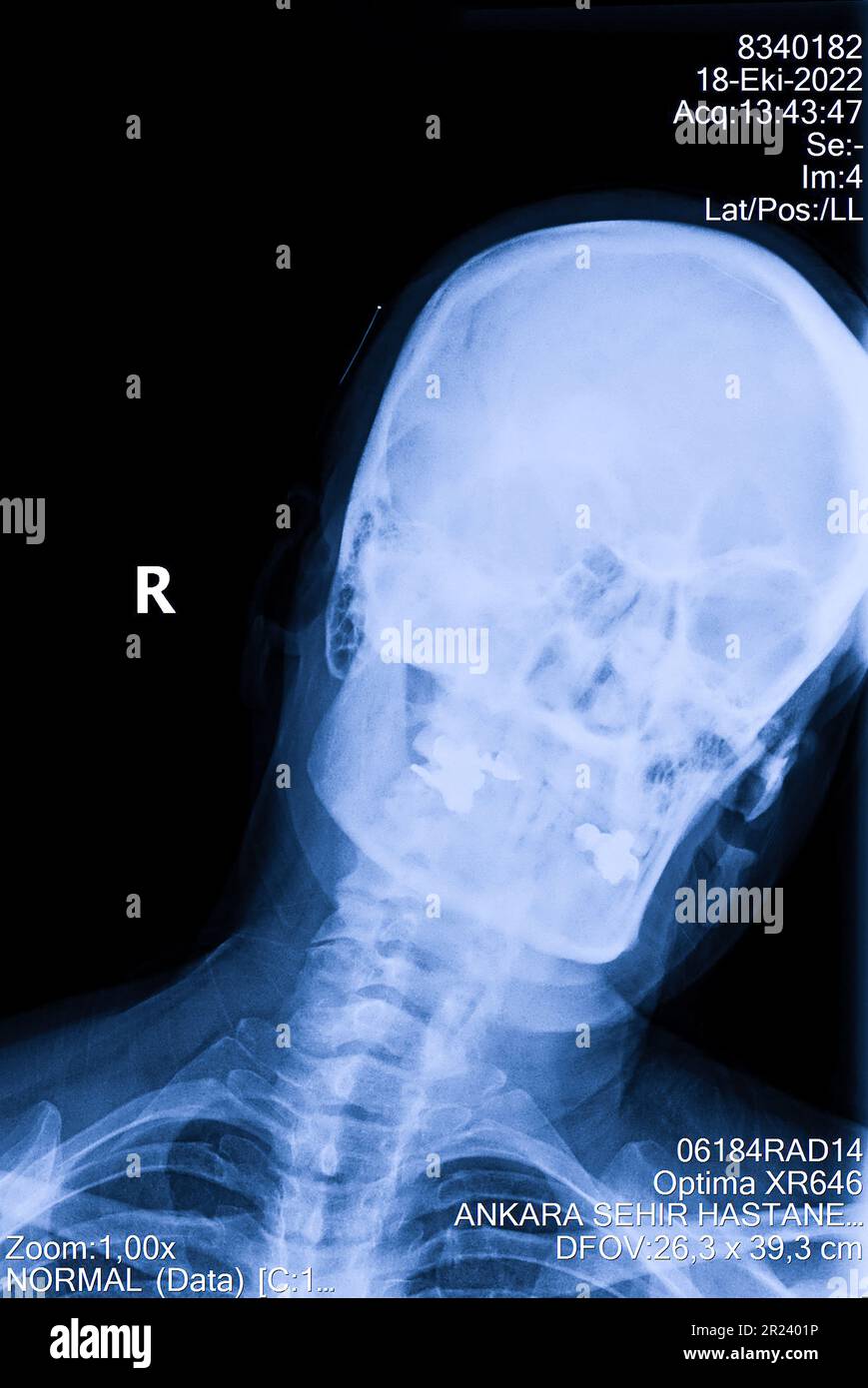Human cervical spine xray, neck radiography Stock Photo Alamy