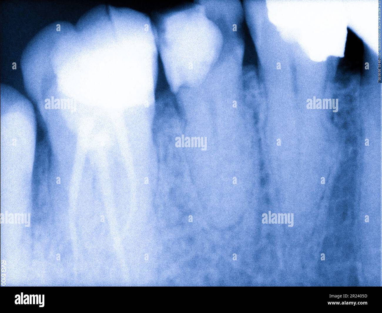 Periodontal diagnostics hires stock photography and images Alamy