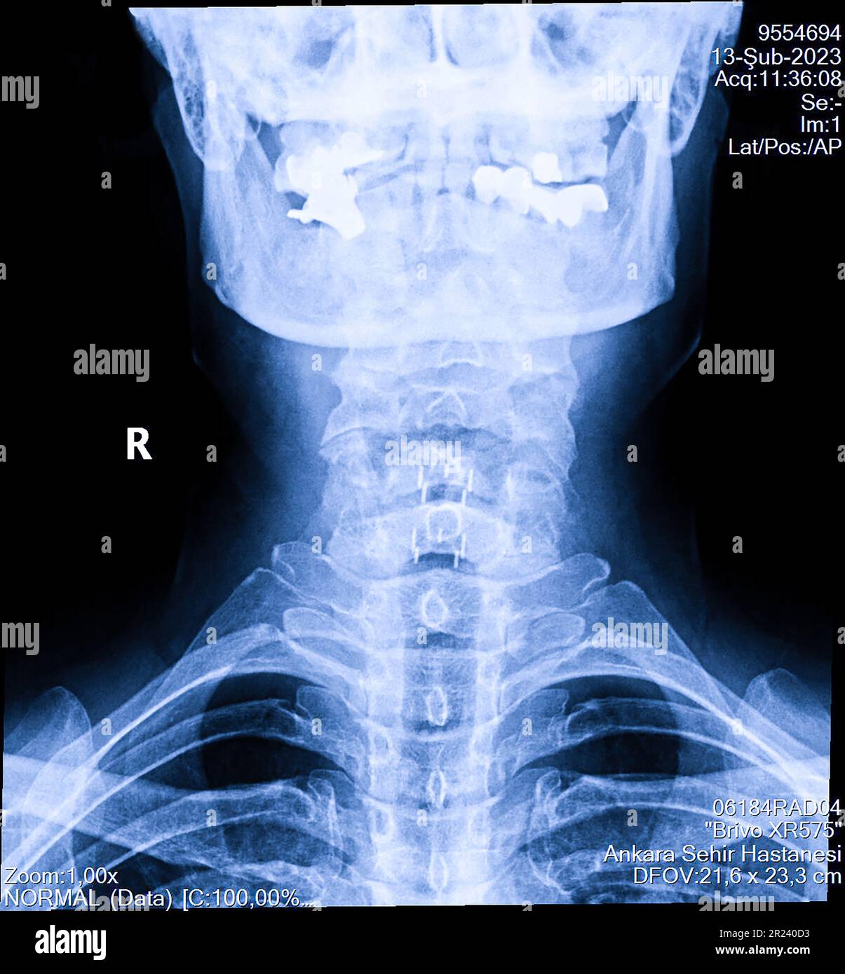 Human cervical spine xray, neck radiography Stock Photo Alamy