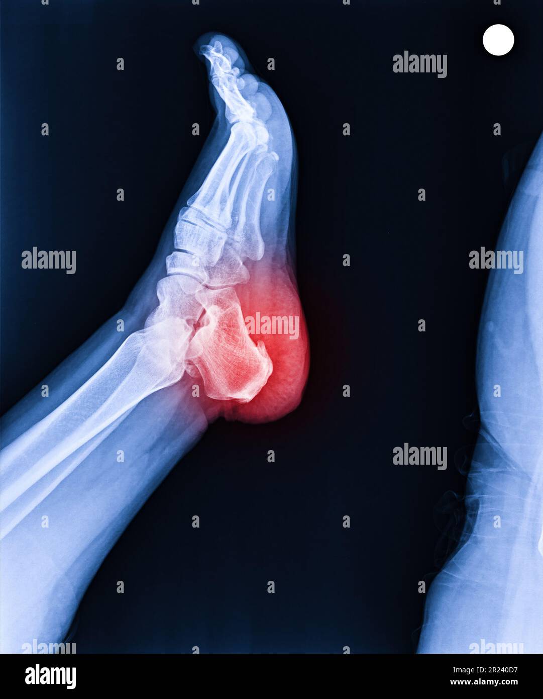 Foot and ankle pain on x-ray, isolated on black background, heel pain, heel spur Stock Photo
