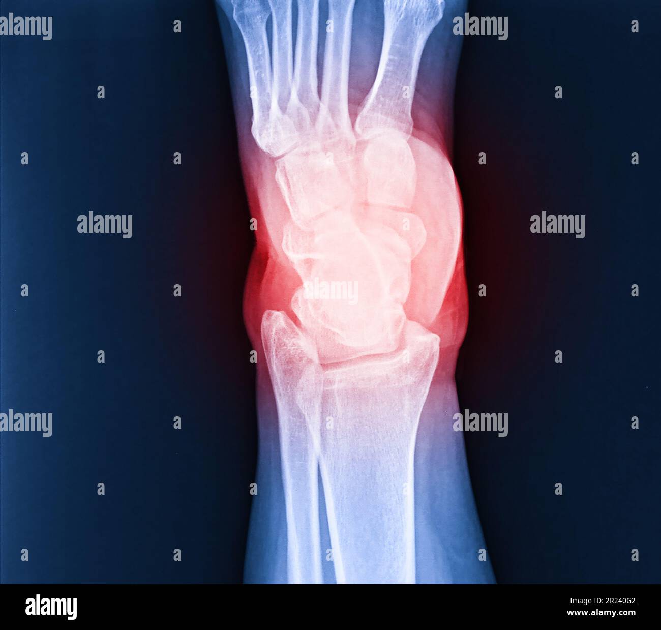 Arthritis at ankle joint (Gout , Rheumatoid arthritis) Stock Photo