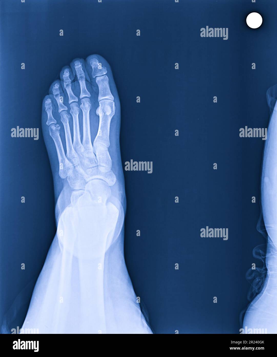 X Ray Of Foot
