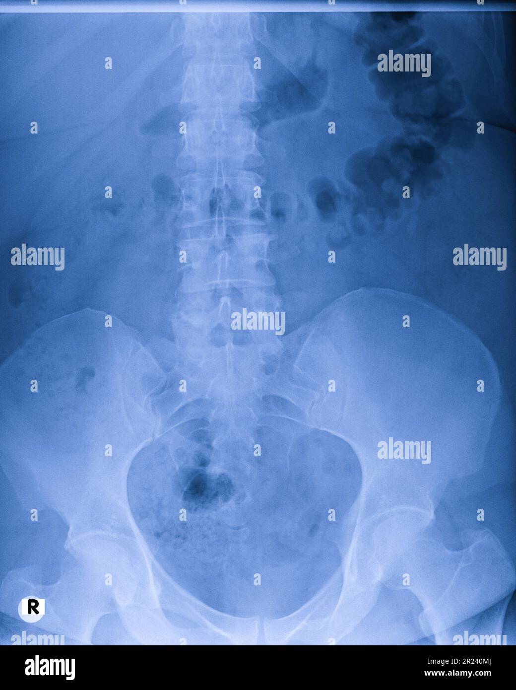 X-ray of the pelvis and spinal column Stock Photo