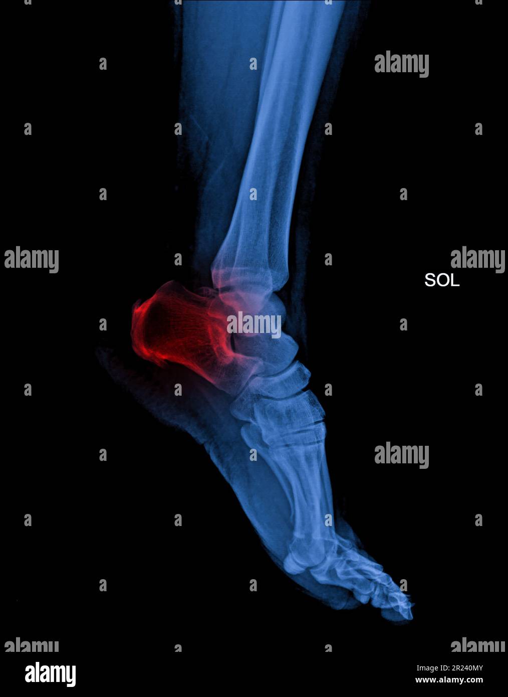Arthritis at ankle joint (Gout , Rheumatoid arthritis Stock Photo Alamy