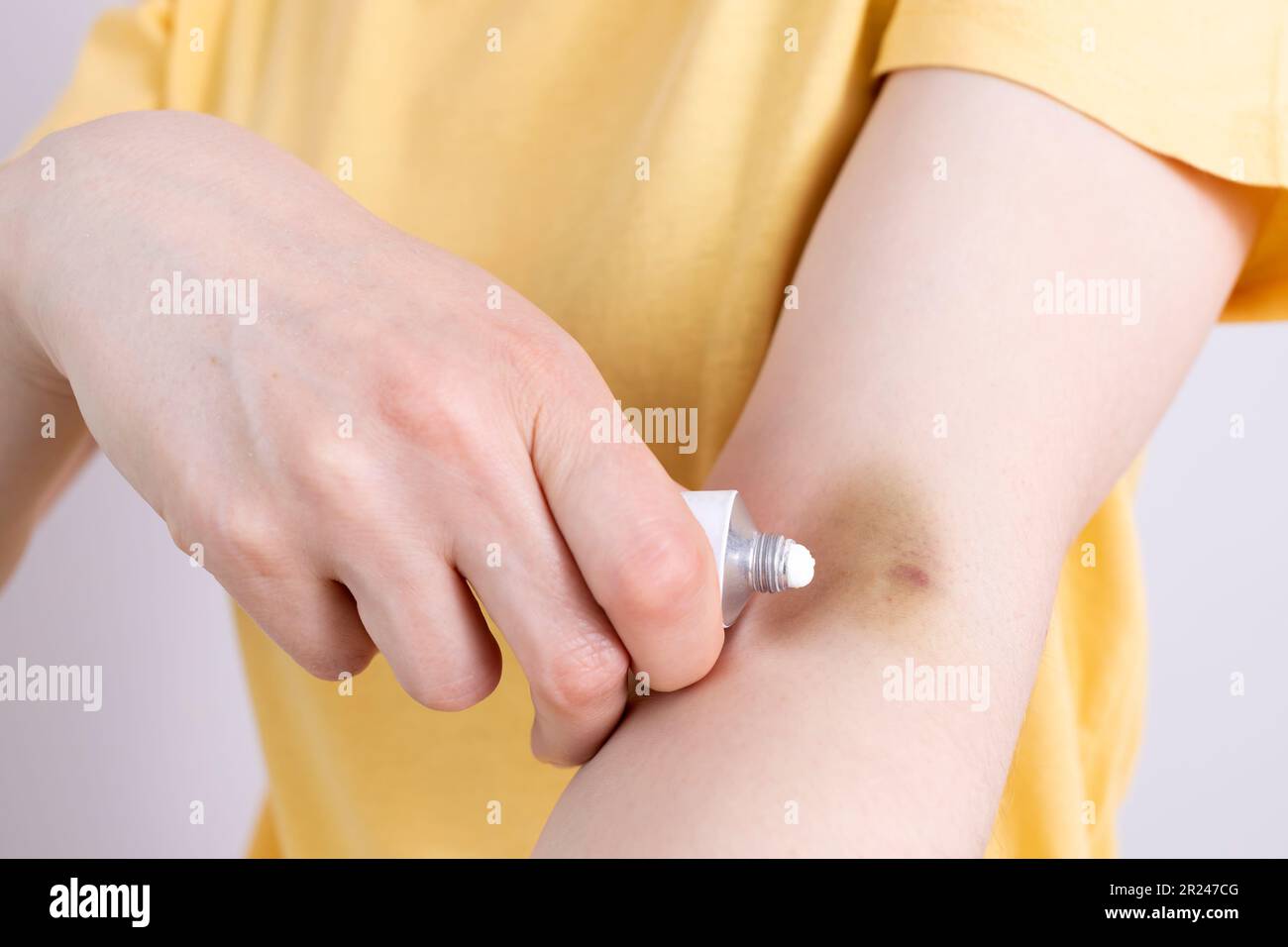 Closeup Female Person Applies Healing Cream, Ointment On Hematoma ...