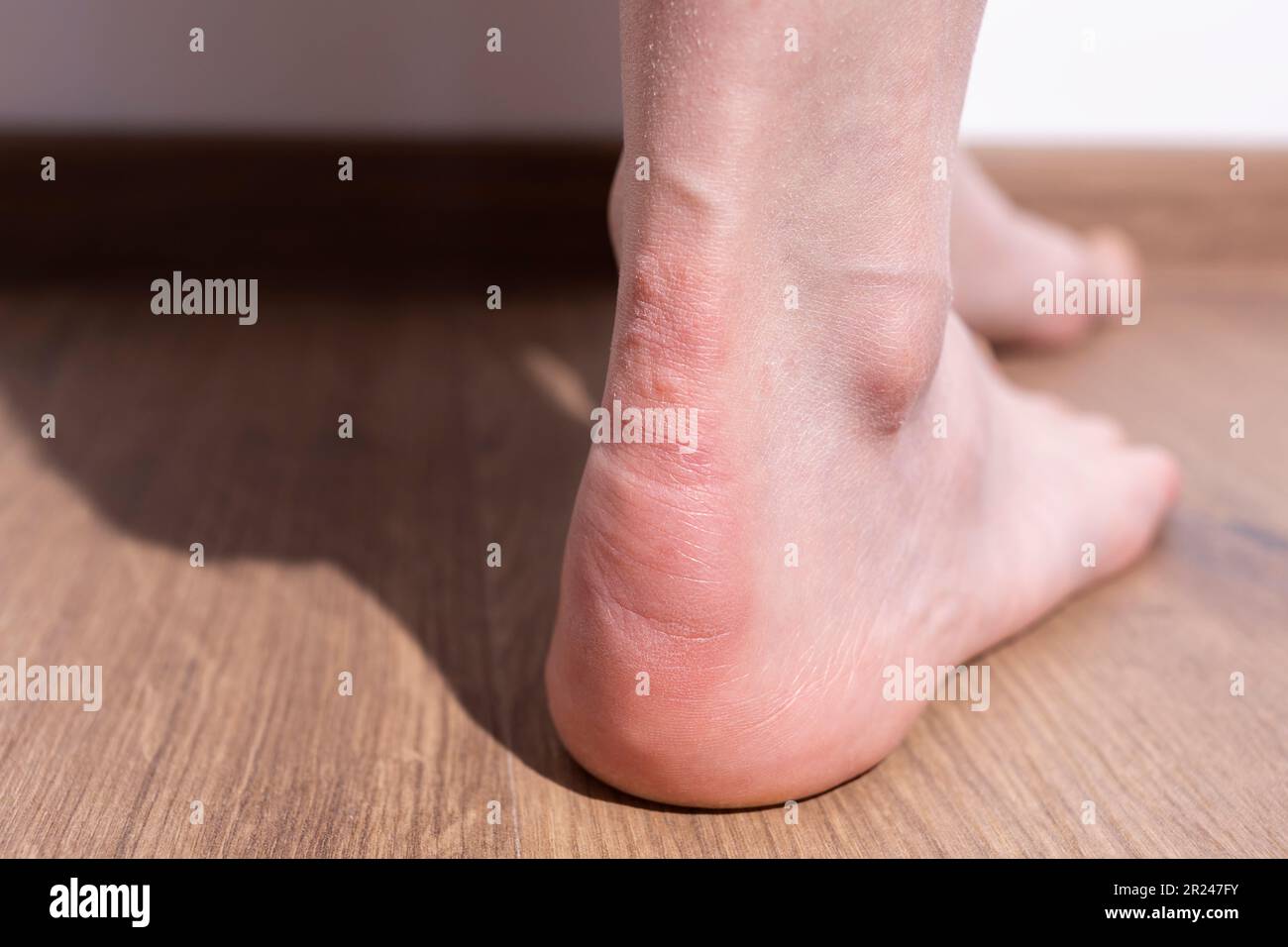 Dead skin on back of ankle deals