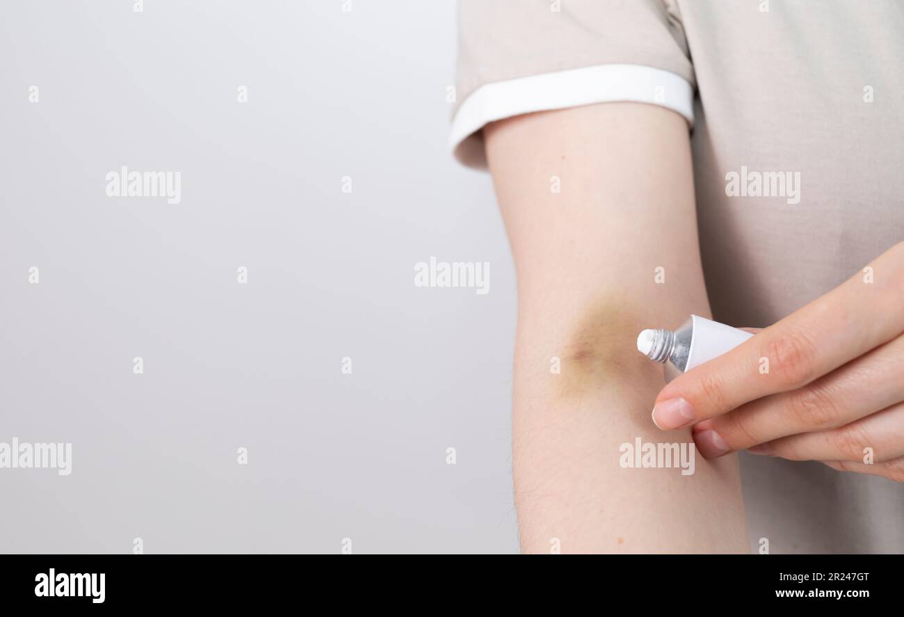 Someone Applies Healing Cream, Ointment On Hematoma, Bruise After ...