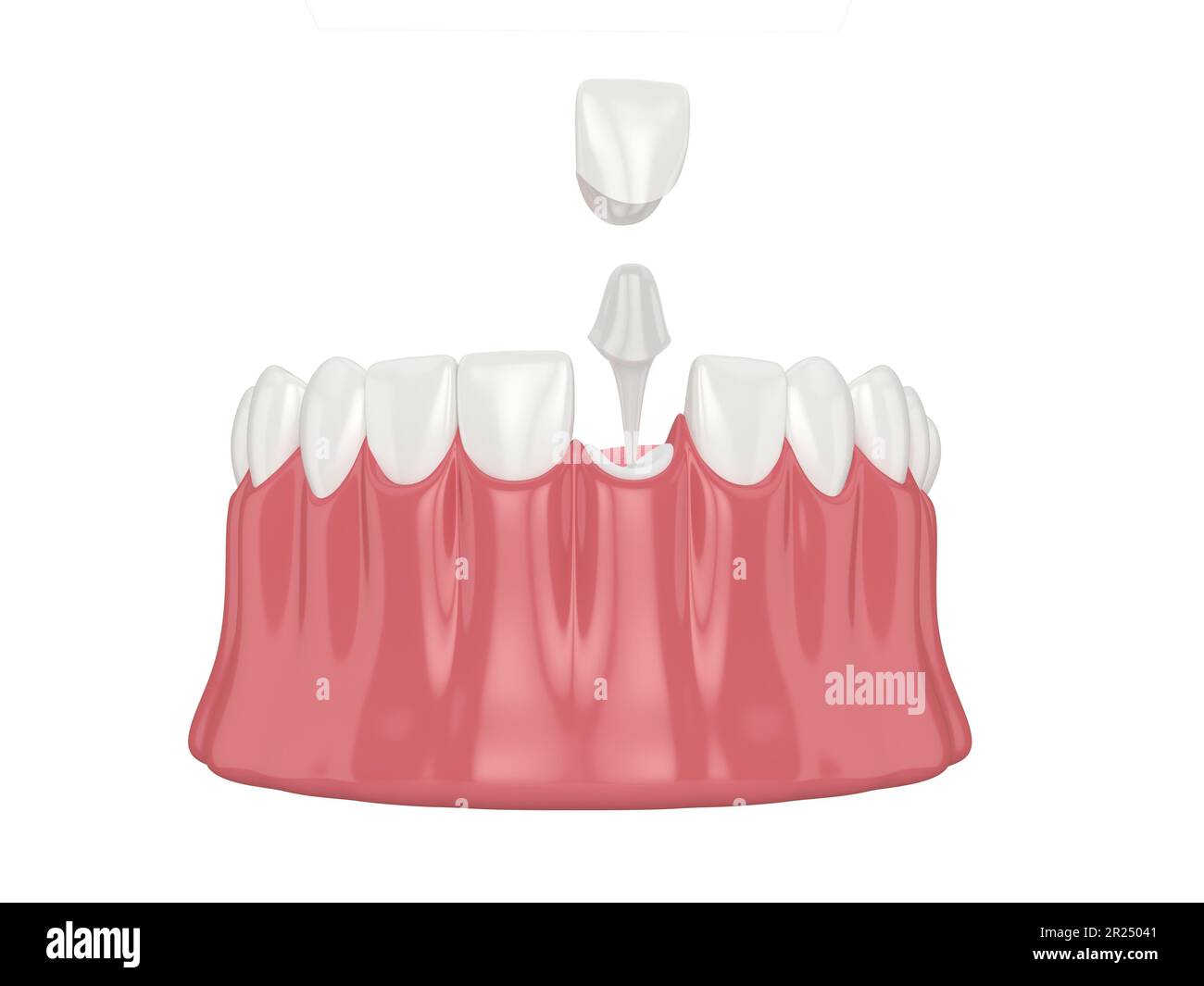 3d render of lower jaw with esthetic post and core tooth restoration over white background Stock