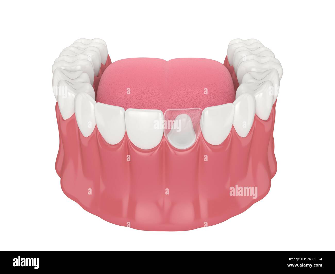 Tooth Core Man 3d render of lower jaw with dental post and core tooth restoration over ...