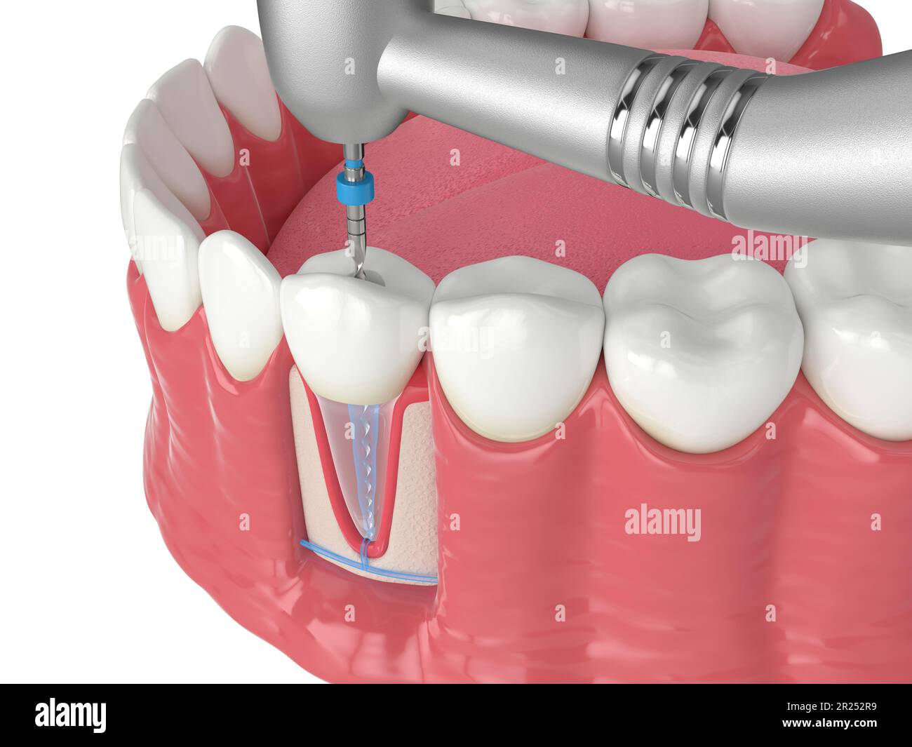 3d render of lower jaw with handpiece and endodontic rotary file over