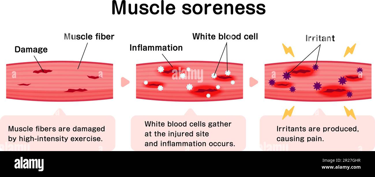 Mechanism Of Muscle Soreness Vector Illustration Stock Vector Image muscle-soreness-chart-that-feeling-after-a-great-workout-legs