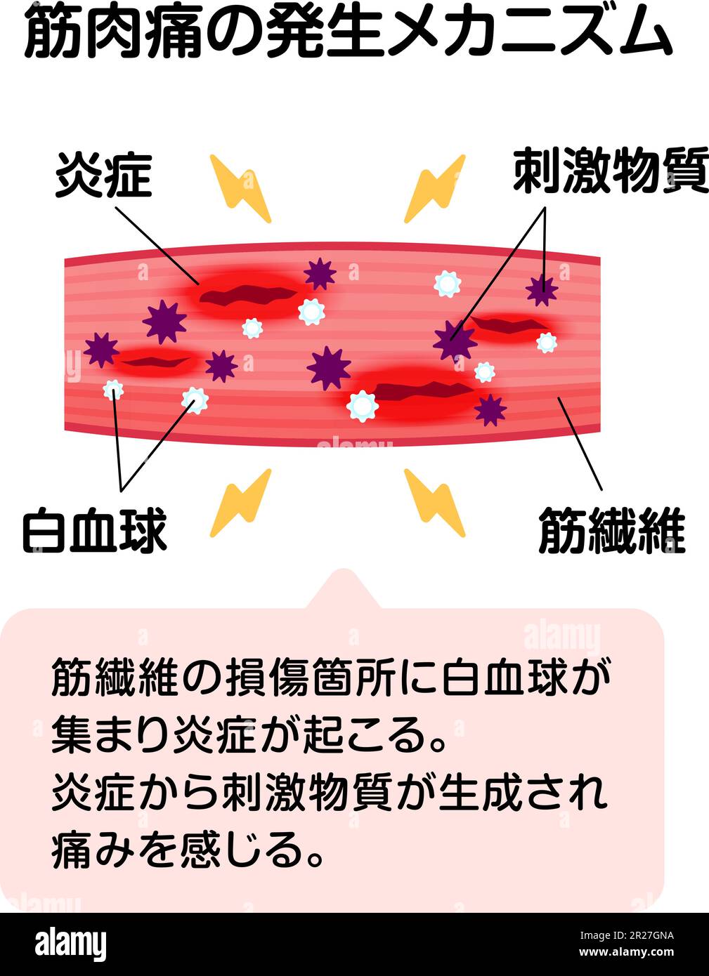 Mechanism of muscle soreness vector illustration Stock Vector Image