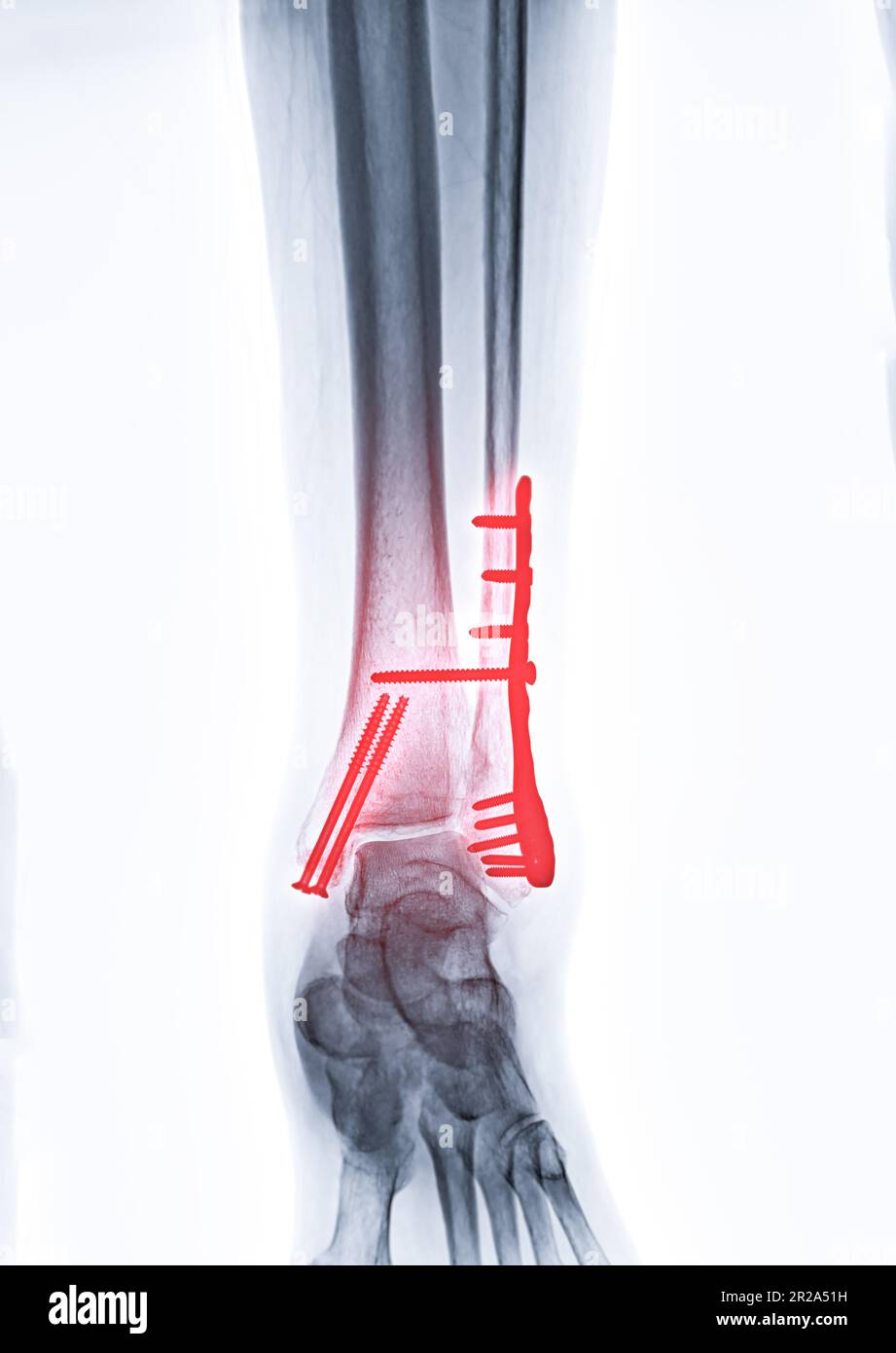 Xray image of ankle joint showing internal fixation with plate and