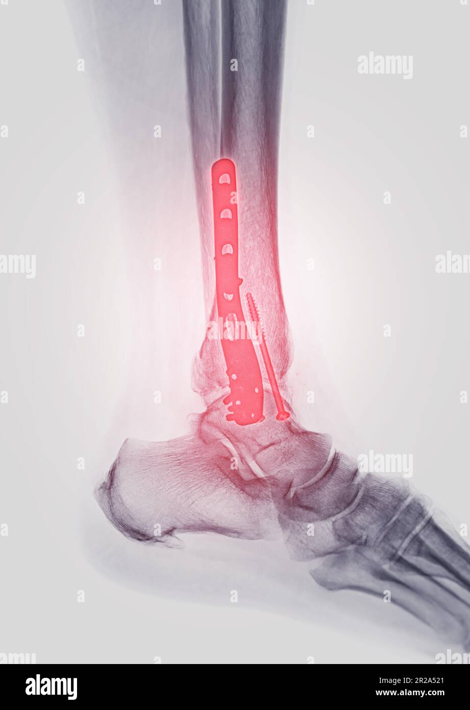 Xray image of ankle joint showing internal fixation with plate and