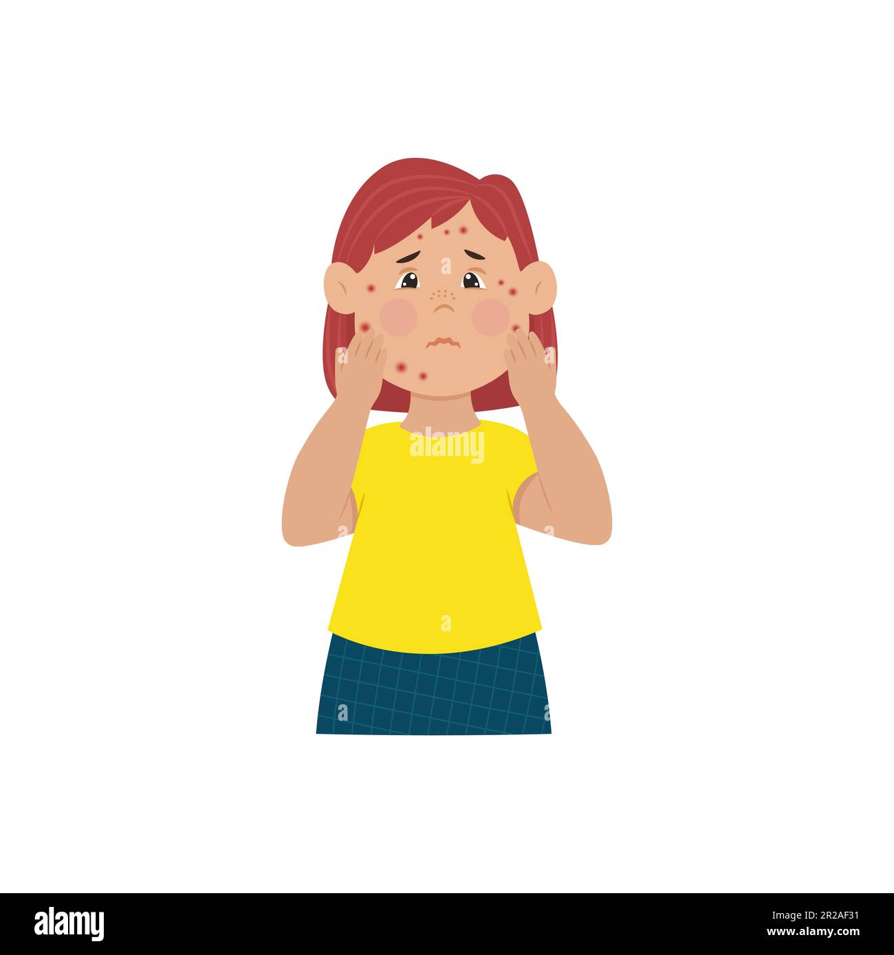 Allergy and infectious rashes on the face in children Vector