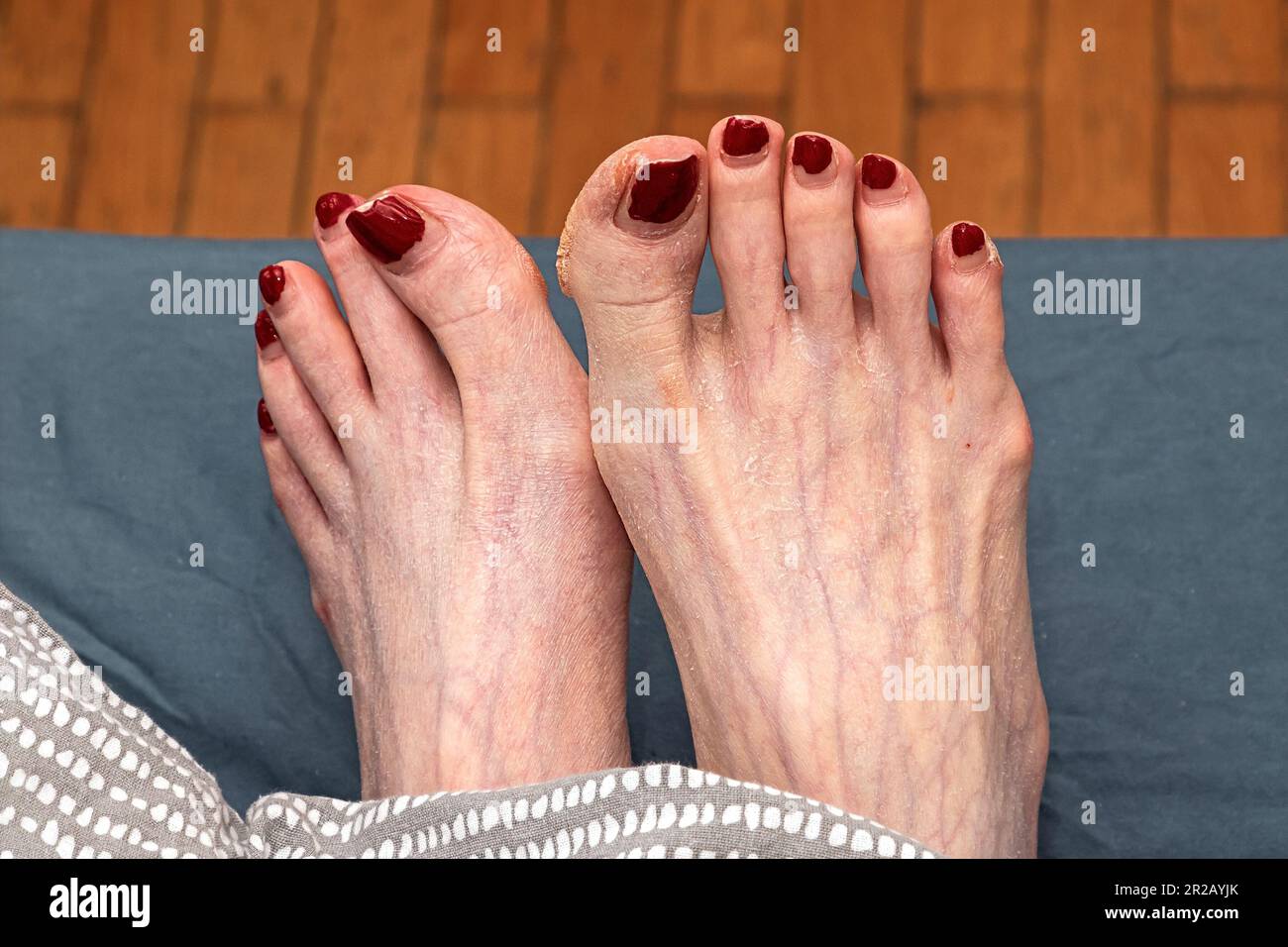Female feet with dry skin and callus blisters and other medical