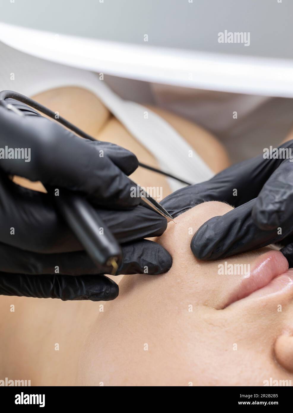 Hirsutism Closeup Dermatologist Removes Hair On Jawline, Chin Of Female Client's Face With Electrolysis Procedure, Electric Epilation In Beauty Salon Stock Photo