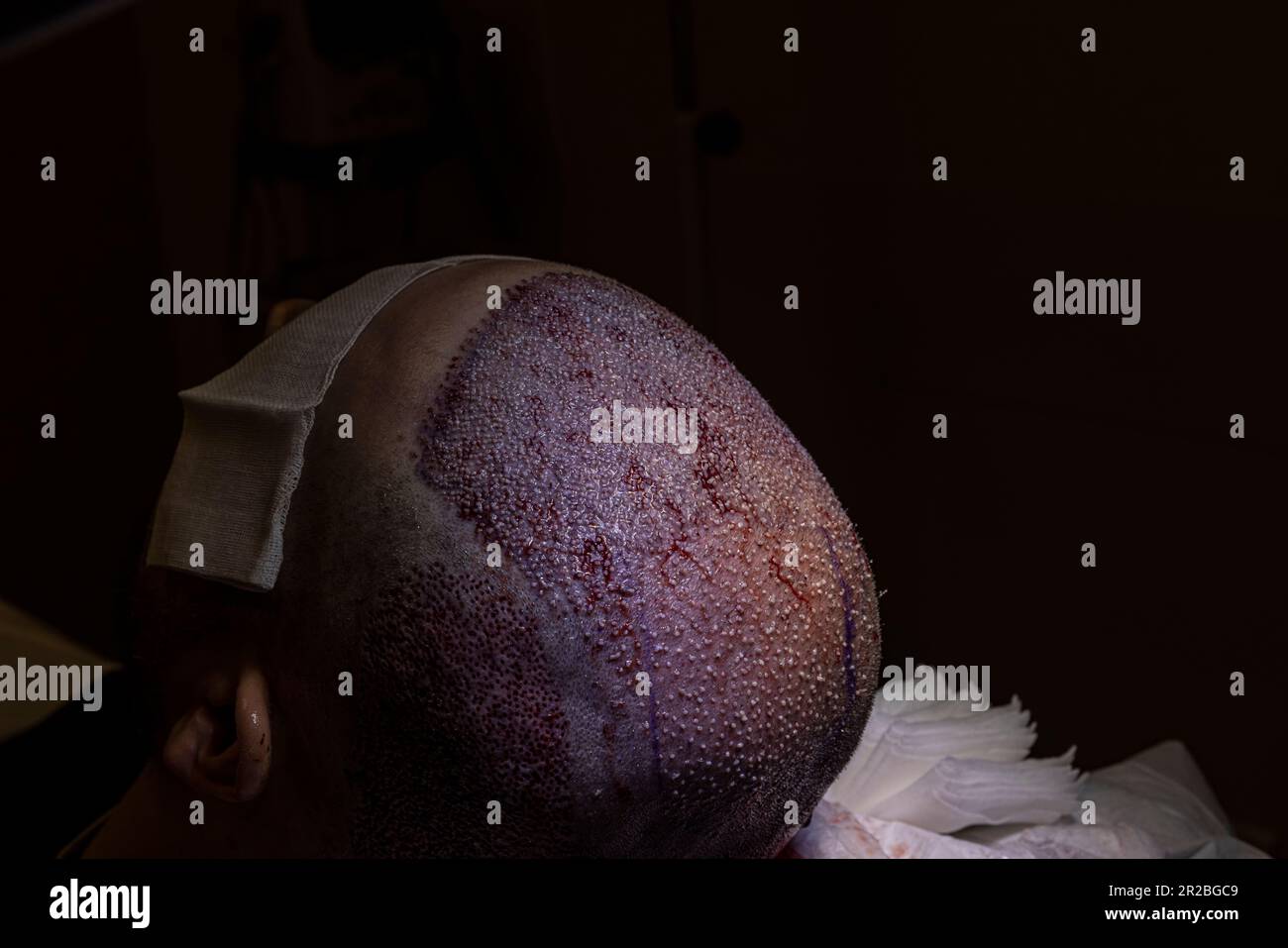 Hair transplantation. Macrophotography of a hair bulb transplanted into a hairless area. Baldness treatment. Hair transplant. Surgeons in the operatin Stock Photo