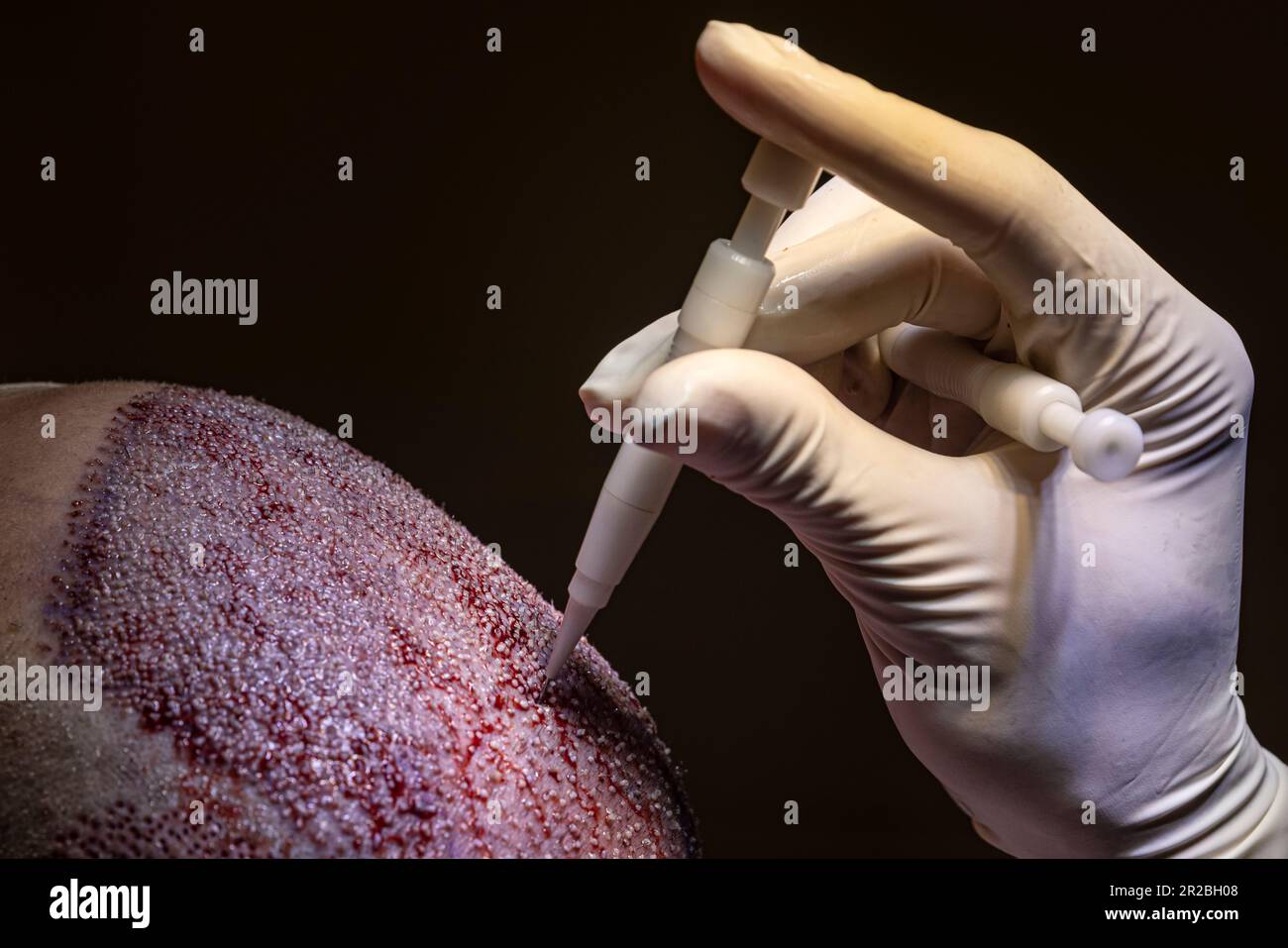 Hair transplantation. Macrophotography of a hair bulb transplanted into a hairless area. Baldness treatment. Hair transplant. Surgeons in the operatin Stock Photo