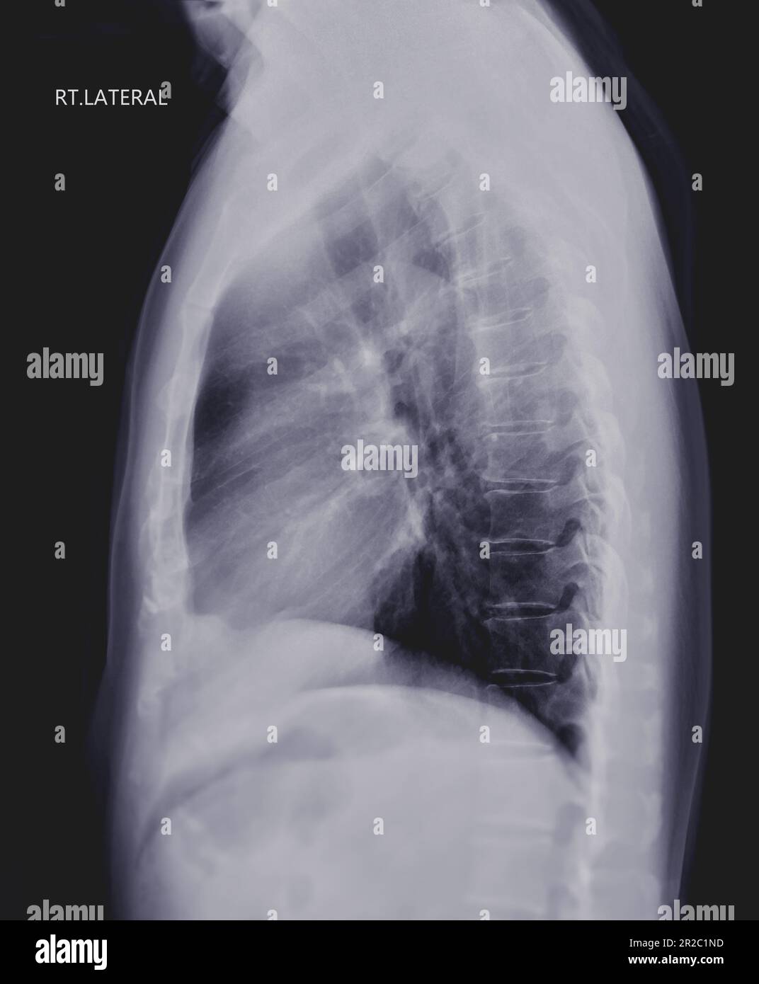 Chest Xray or XRay Image of Human Lung Lateral View with full