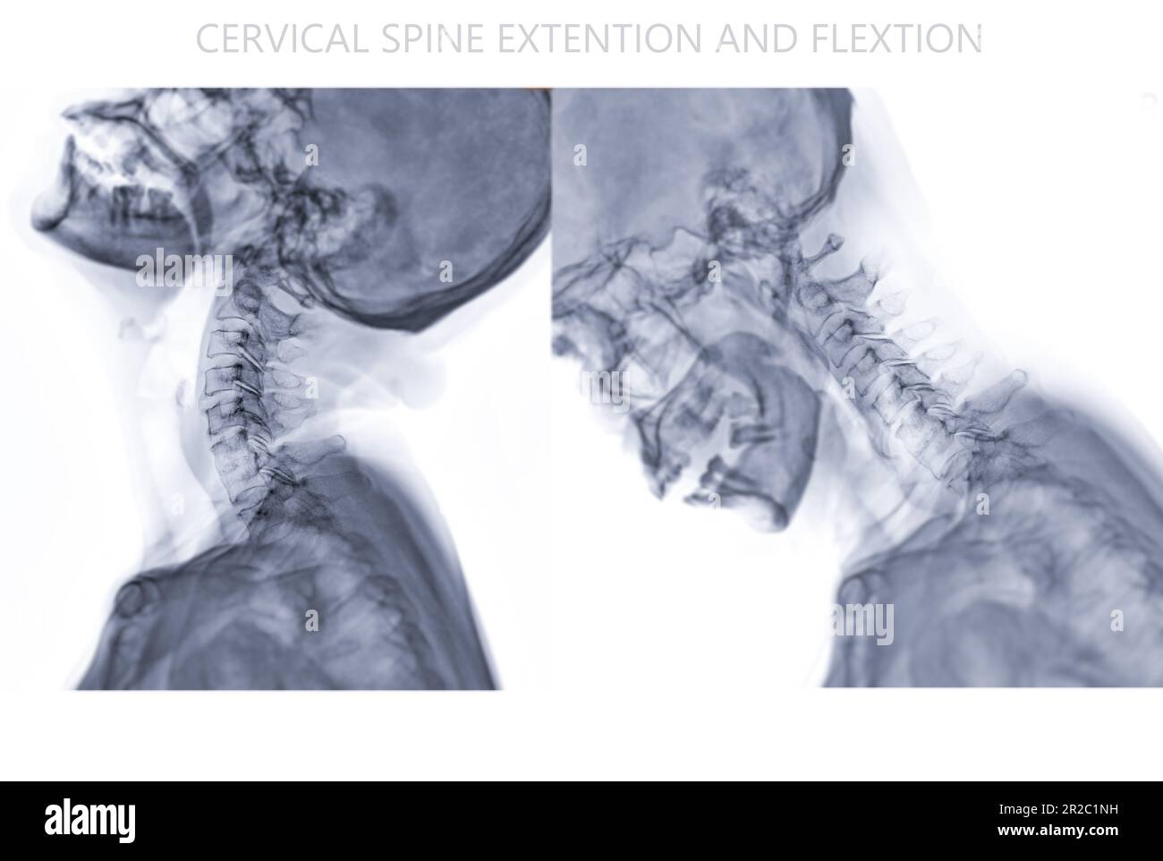 Xray Cspine or xray image of Cervical spine Flexion and Extension viewfor diagnostic