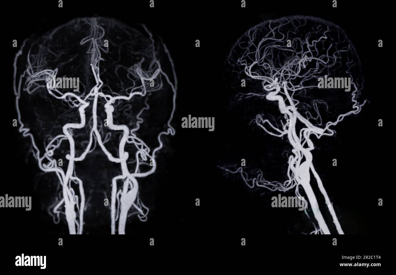 CT angiography of the brain or CTA brain showing Cerebral artery Stock ...