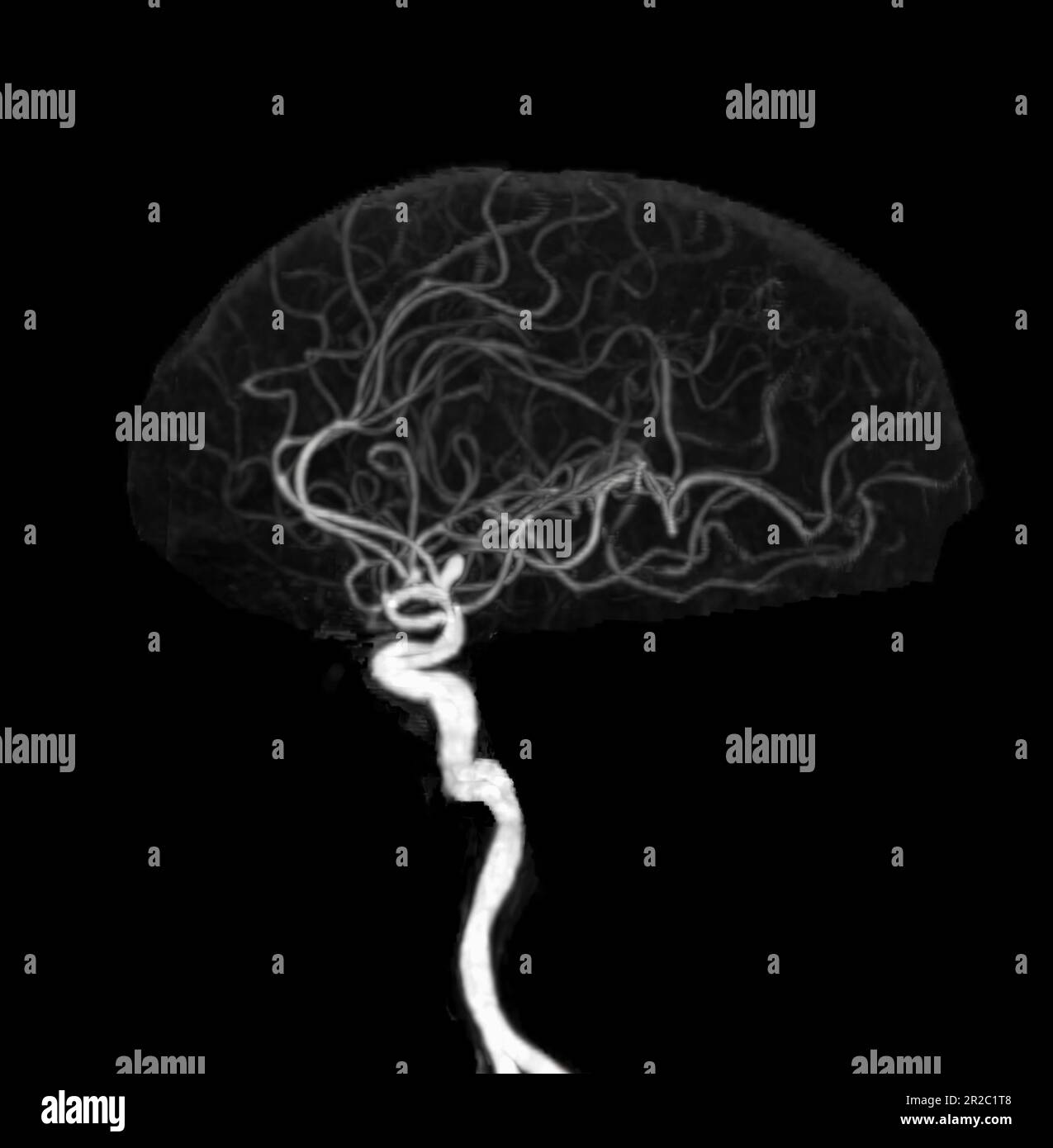 3d cerebral angiography hi-res stock photography and images - Alamy