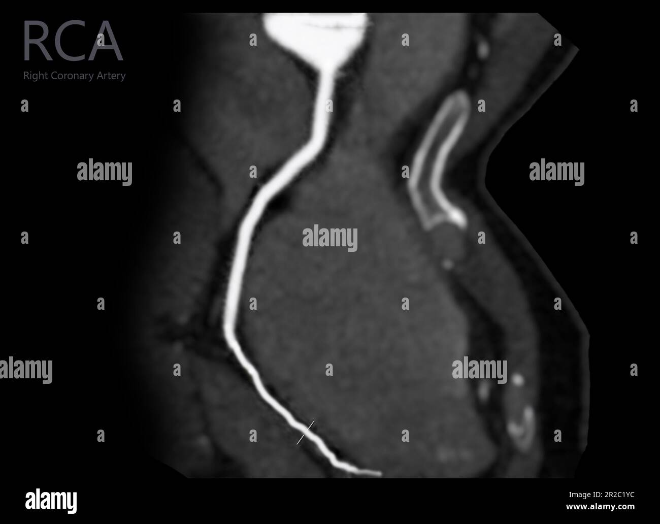 CTA coronary artery Curve refomation showing Right coronary artery . Stock Photo