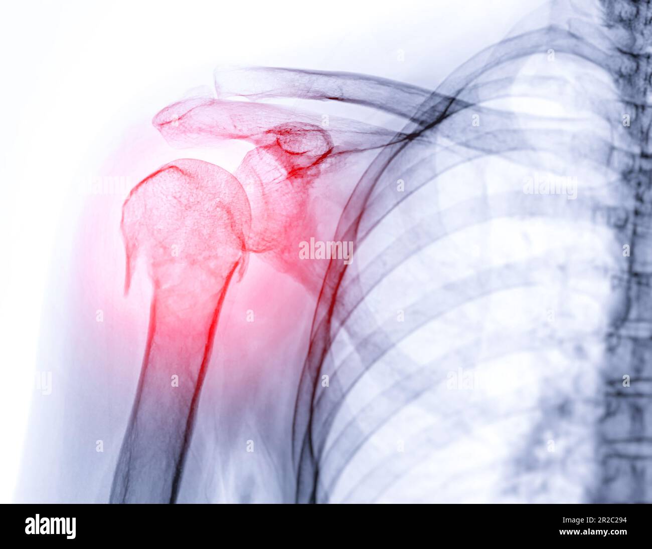 Xray of Shoulder joint showing fracture of humerus bone Stock Photo Alamy