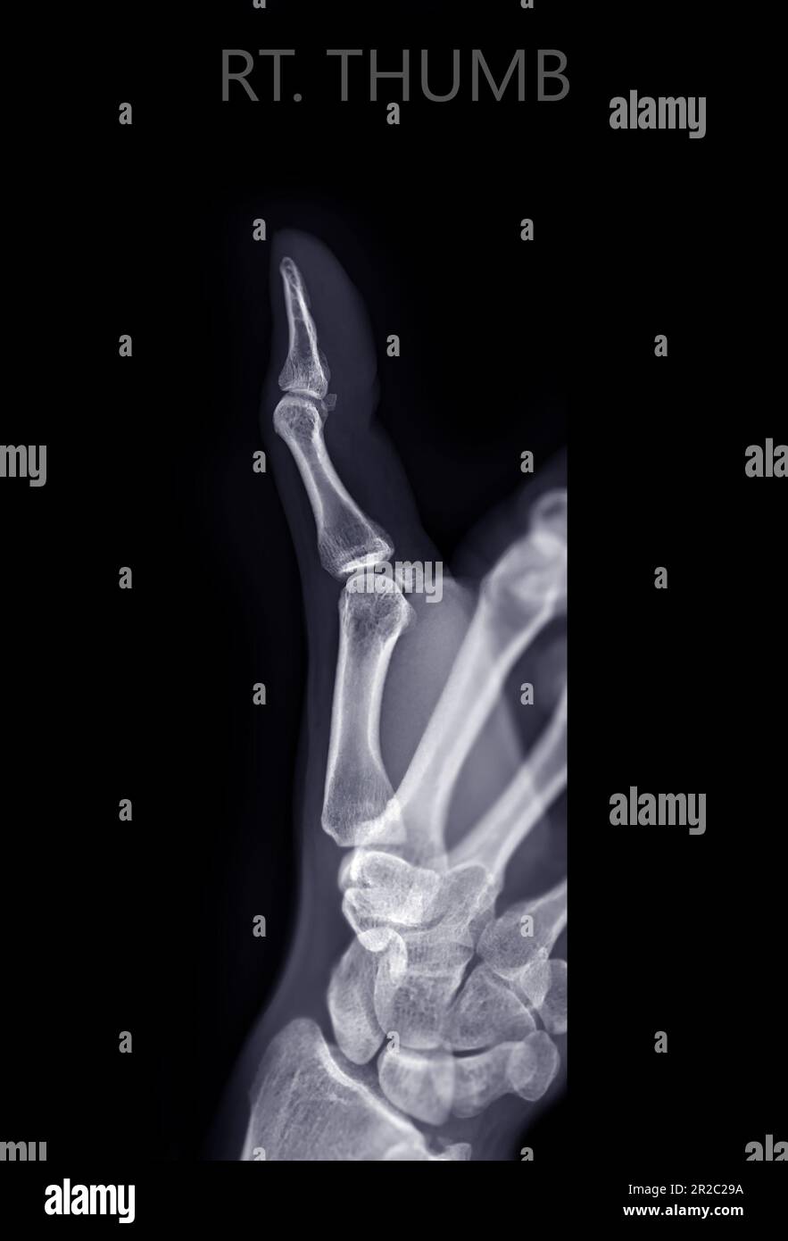 x-raiy image of thumb finger. Stock Photo