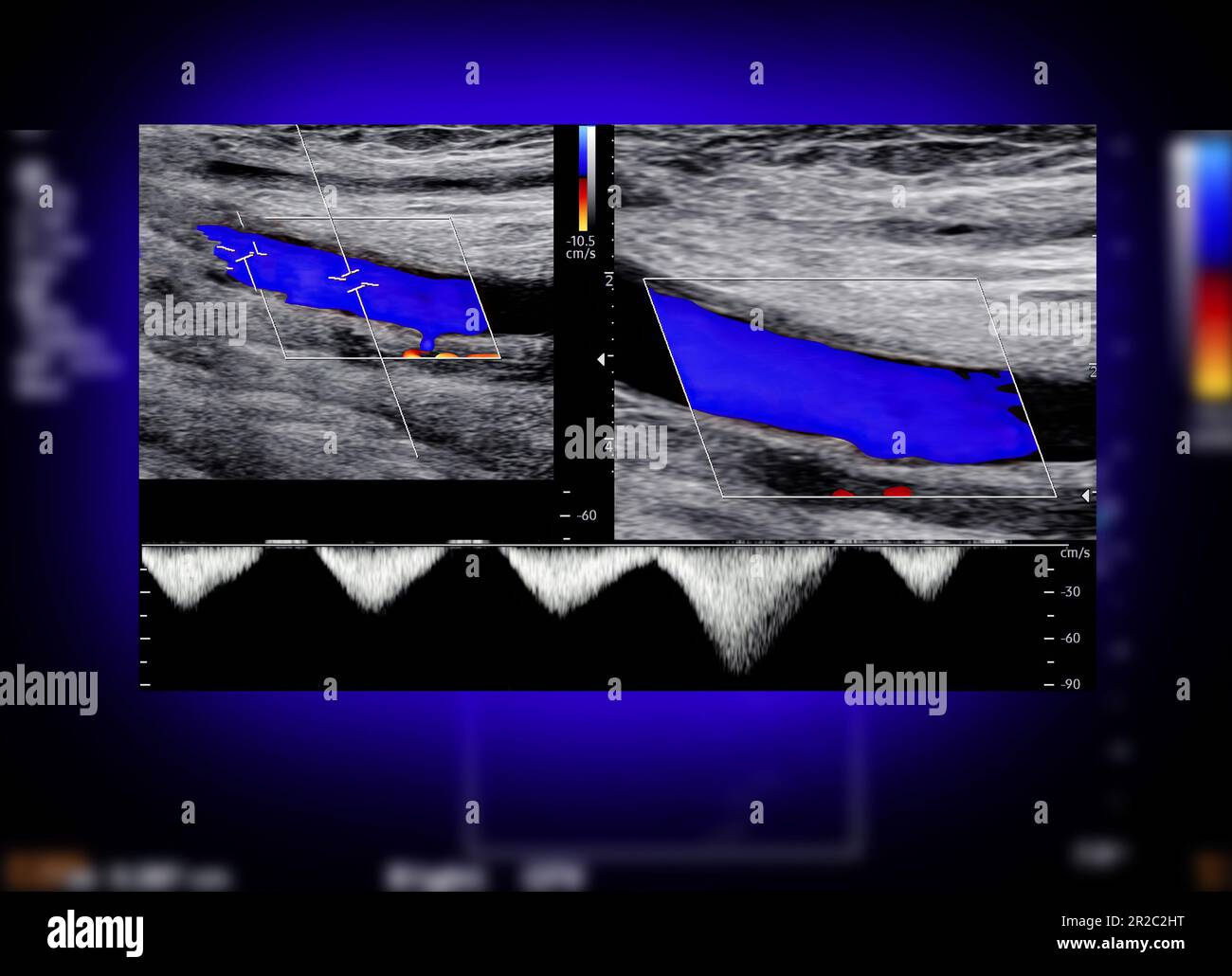 A carotid artery Doppler ultrasound is a diagnostic test used to check
