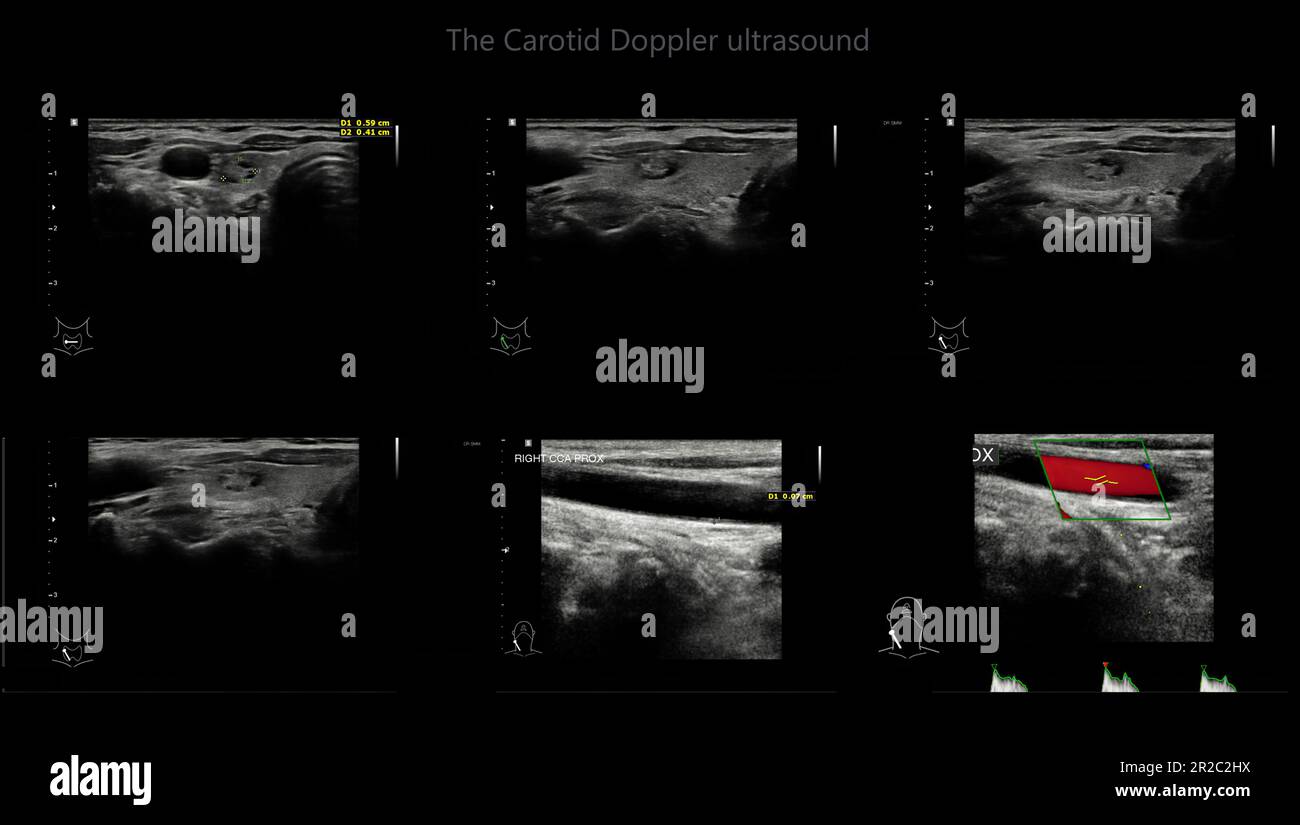 A carotid artery Doppler ultrasound is a diagnostic test used to check ...