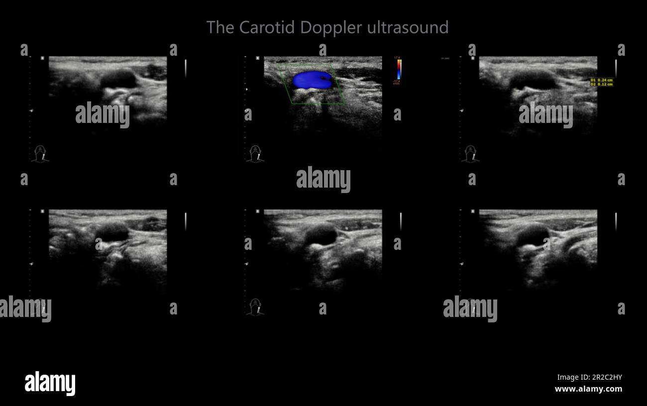 A carotid artery Doppler ultrasound is a diagnostic test used to check