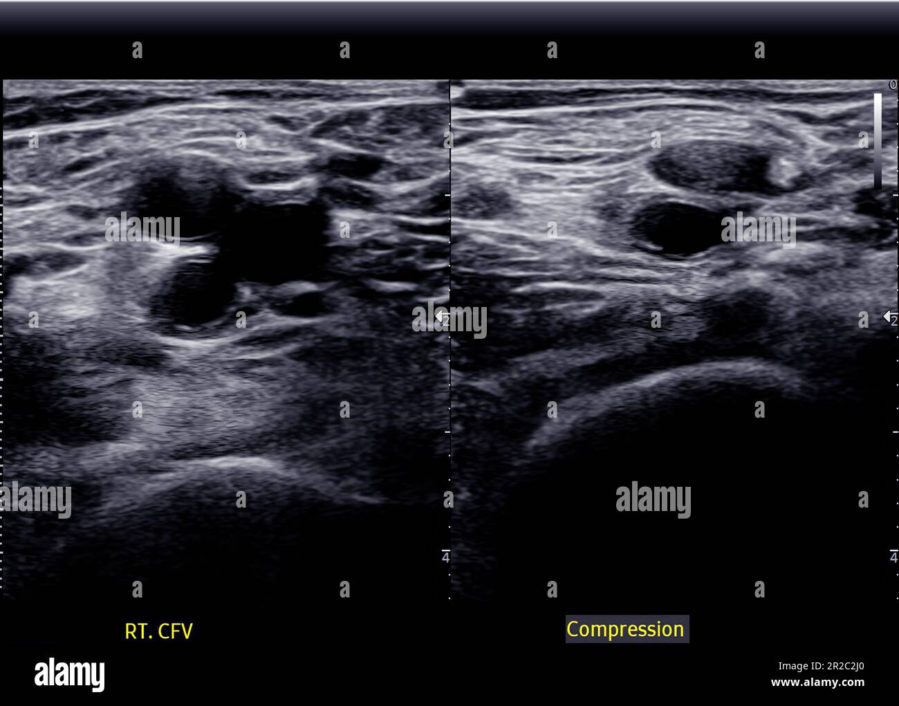A carotid artery Doppler ultrasound is a diagnostic test used to check