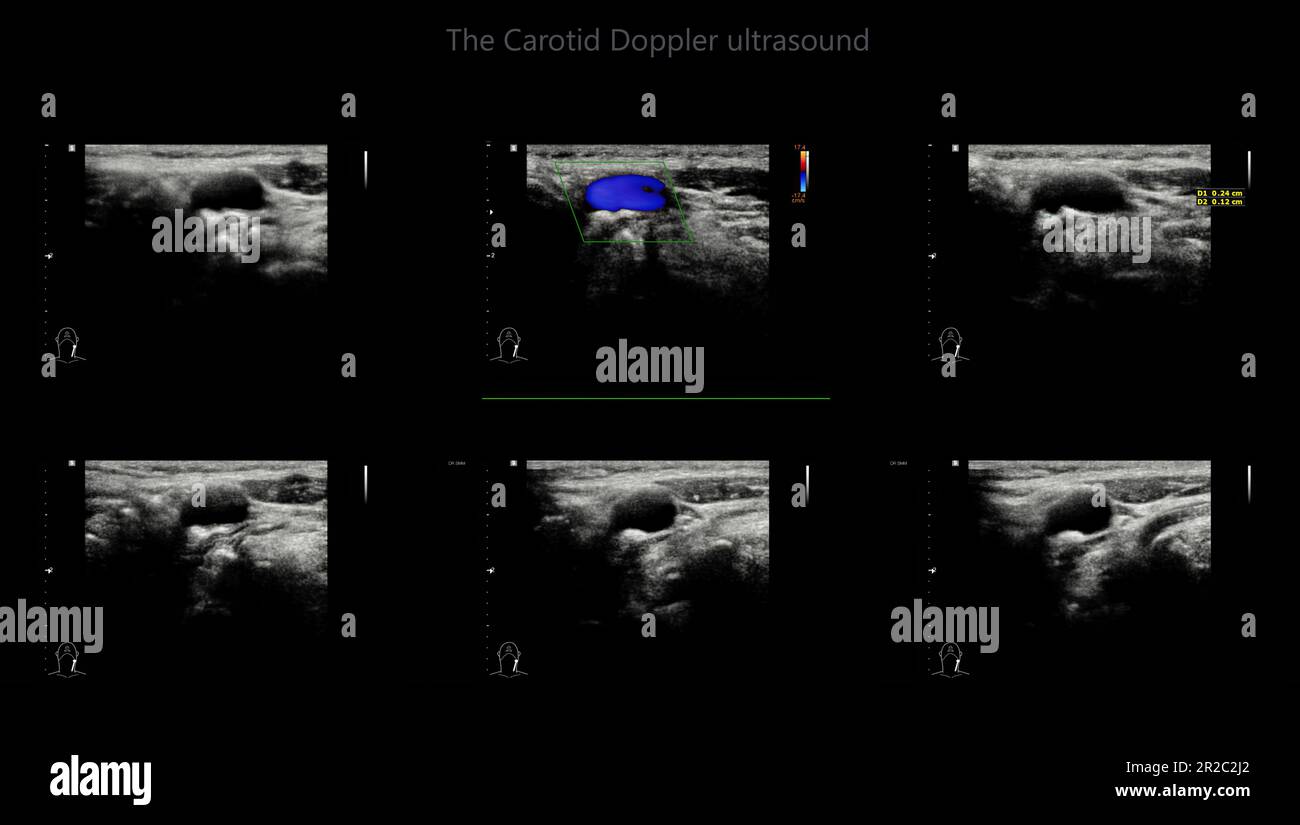 A Carotid Artery Doppler Ultrasound Is A Diagnostic Test 47 Off