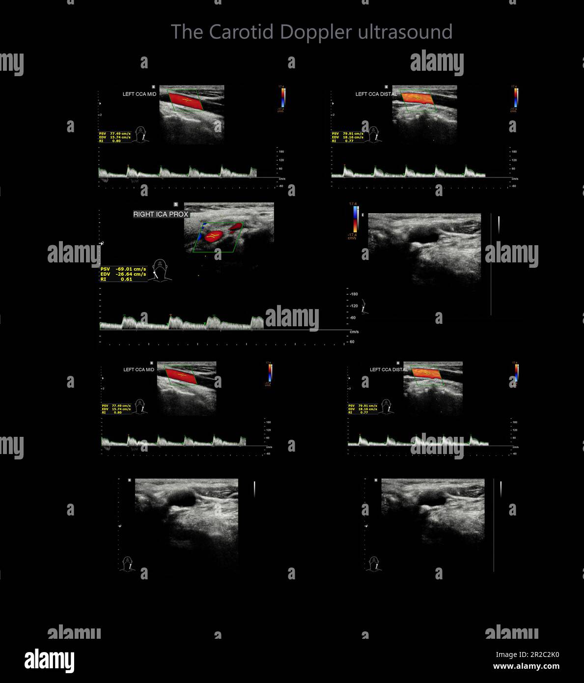 A carotid artery Doppler ultrasound is a diagnostic test used to check