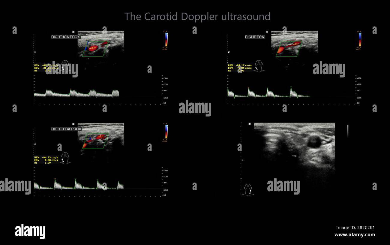 A carotid artery Doppler ultrasound is a diagnostic test used to check