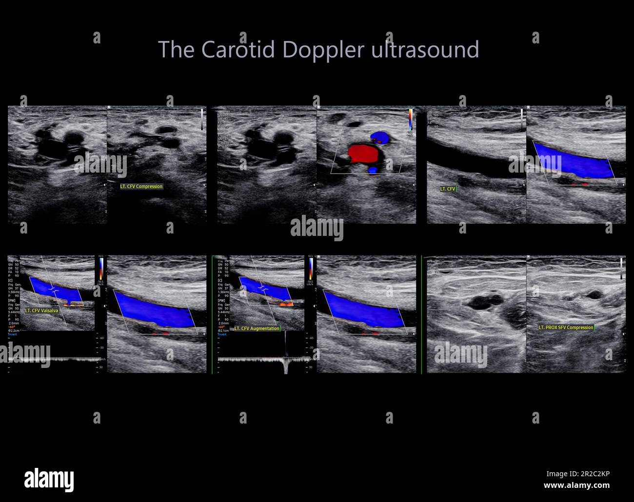 A carotid artery Doppler ultrasound is a diagnostic test used to check
