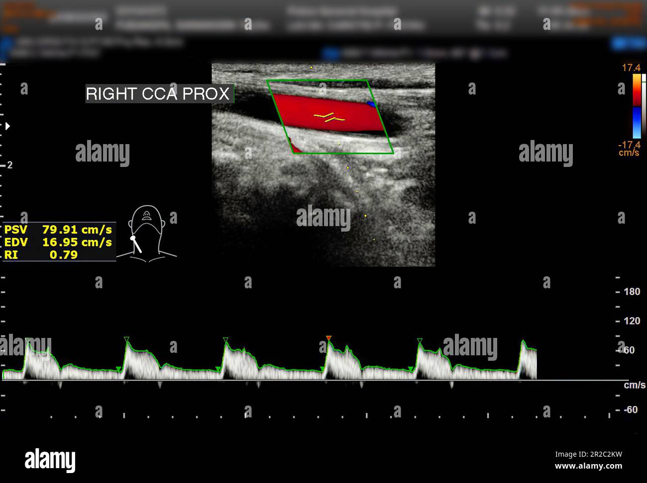A carotid artery Doppler ultrasound is a diagnostic test used to check