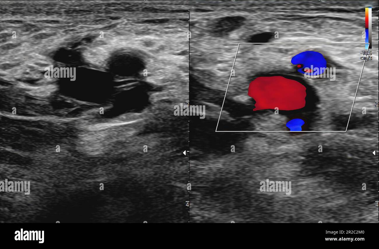 A carotid artery Doppler ultrasound is a diagnostic test used to check