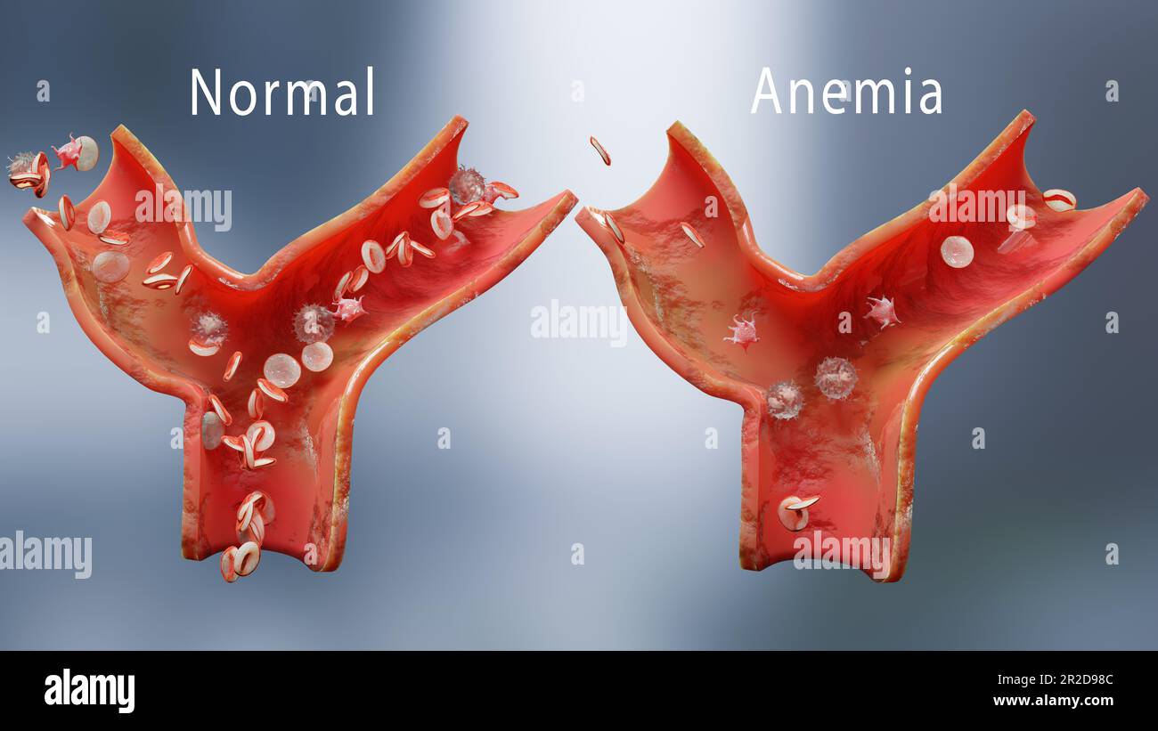 Anemia amount of blood cell or hemoglobin and normal. Aplastic anemia, normal and abnormal blood cell and platelets count, circulation in an artery or Stock Photo
